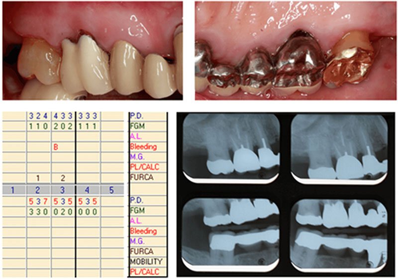 Surgical Dental Treatment Roseville Case Study