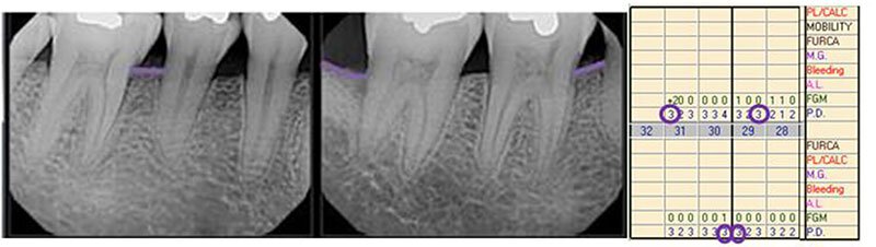 Surgical Dental Treatment Roseville Regenerative Case Study 3